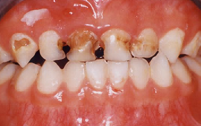 乳牙齲齒防治（乳牙根管*、預(yù)成冠）